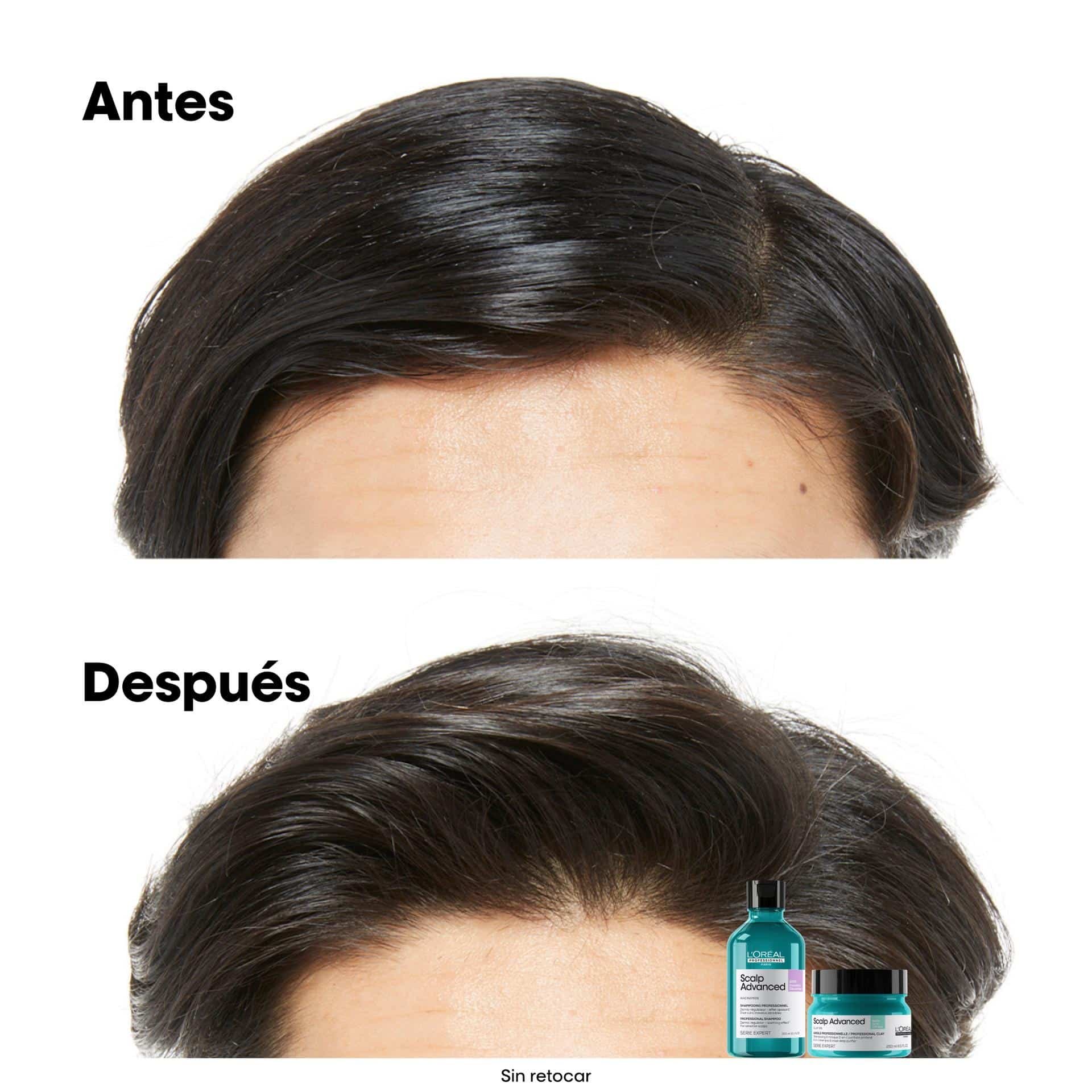 Champú Scalp Anti Grasa 300 ml