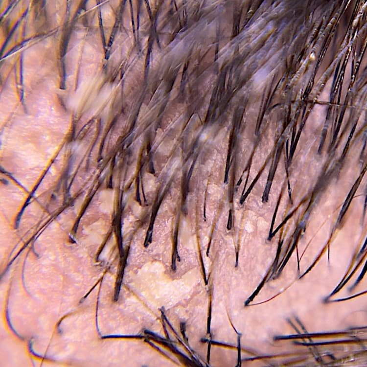 Primer plano de un cuero cabelludo con descamación y caspa visible, que ilustra la necesidad de un cuidado y tratamiento específicos y eficaces del cuero cabelludo.