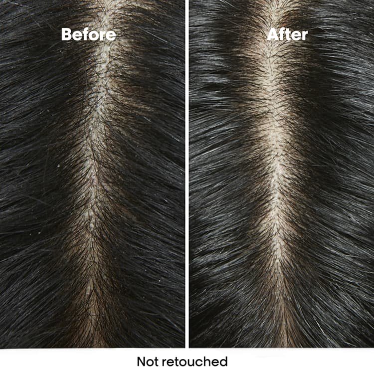 Antes y después del cuero cabelludo de una mujer, visiblemente más sano y libre de caspa tras seguir una rutina de cuidado anticaspa.